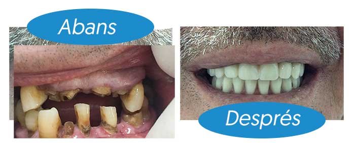 dentadura-clivadent