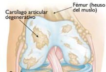 Beneficios de usar Orthovisc en el tratamiento de la osteoartritis