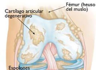 Beneficios de usar Orthovisc en el tratamiento de la osteoartritis